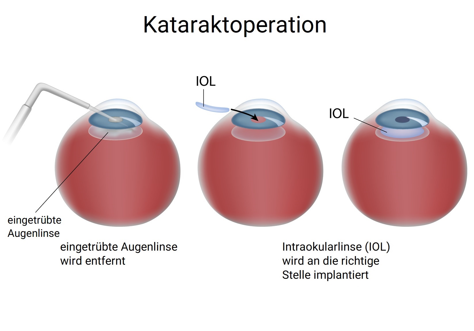 Grauer Star Katarakt Operation Behandlung Mit Laser Und Ultraschall