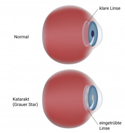 Grauer Star (Katarakt): 6 Häufige Symptome Frühzeitig Erkennen!